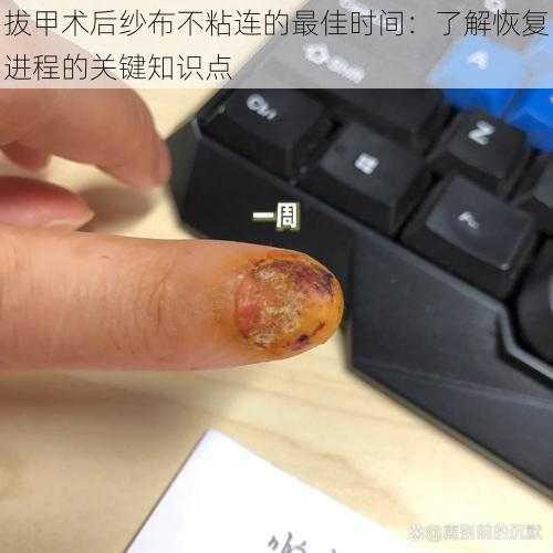 拔甲术后纱布不粘连的最佳时间：了解恢复进程的关键知识点