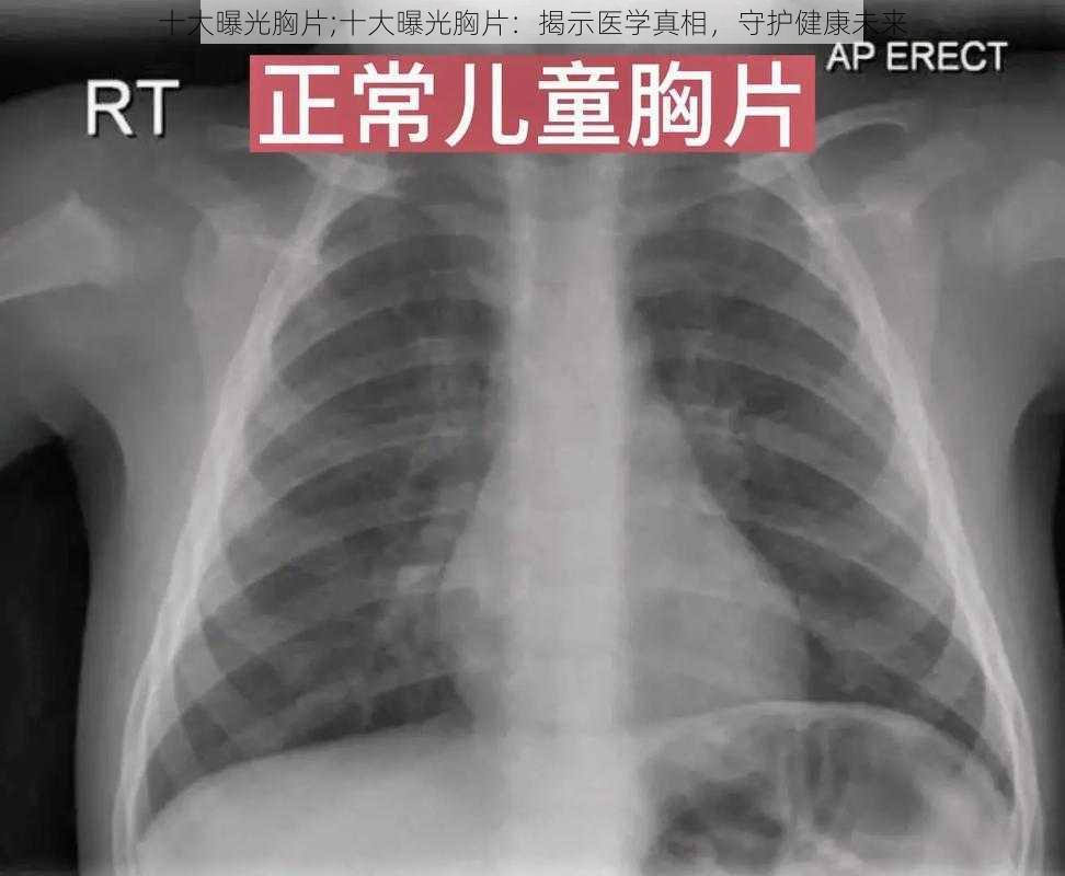 十大曝光胸片;十大曝光胸片：揭示医学真相，守护健康未来